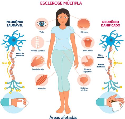 esclerose múltipla sintomas.